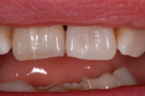 Upper right all-ceramic crown