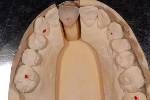 Upper right all-ceramic crown