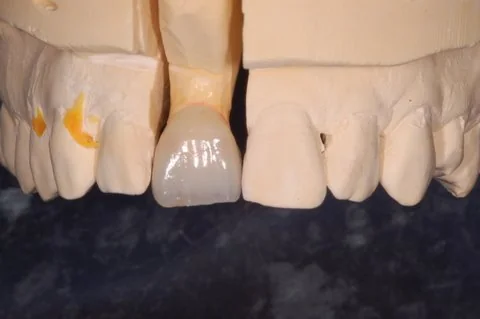 Upper right all-ceramic crown