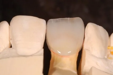 All-ceramic crown on its die, beside the model