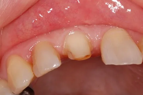 Upper right all-ceramic crown