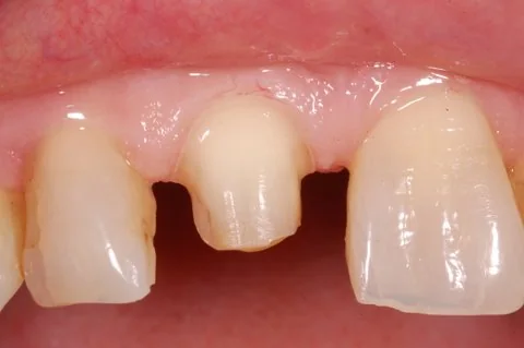 Upper right all-ceramic crown