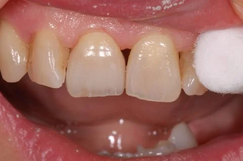 Upper right all-ceramic crown