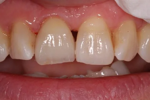 Upper right all-ceramic crown