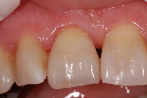 Upper right all-ceramic crown