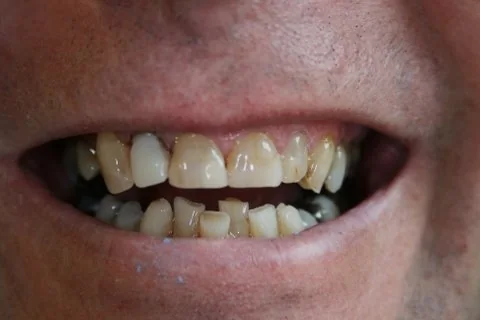 Upper right and left lateral. Upper right lateral, to be restored